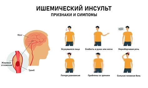 Ишемический инсульт: характеристики и симптомы