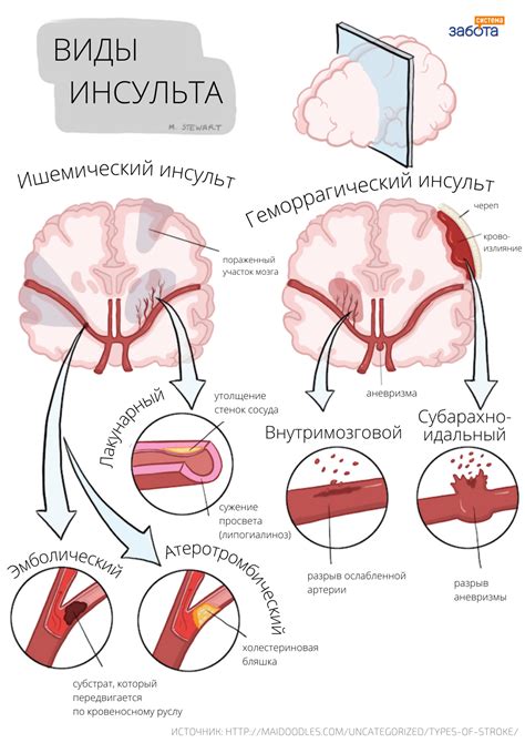 Ишемический инсульт и его виды