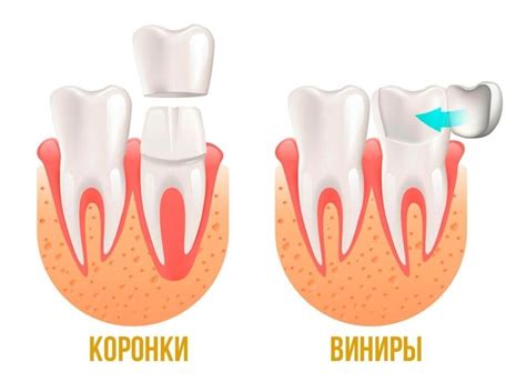 Как выбрать между виниром и коронкой