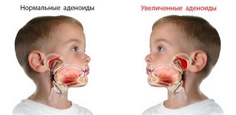 Как избежать повышения температуры после удаления аденоидов