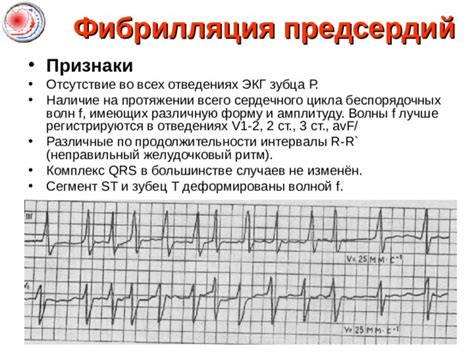 Как определить наличие S-типа на электрокардиограмме у взрослого