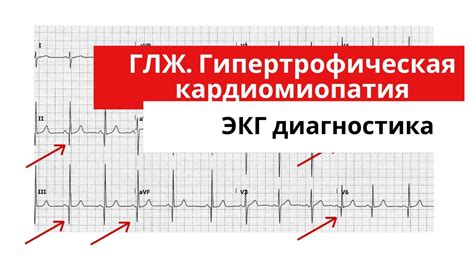 Как определить явные изменения в работе левого желудочка сердца: признаки и диагностика