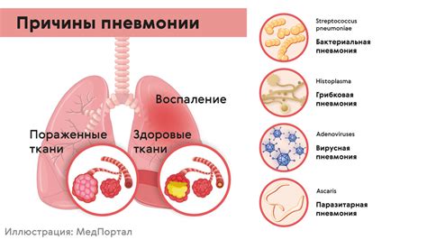 Классификация и симптомы различных типов пневмонии