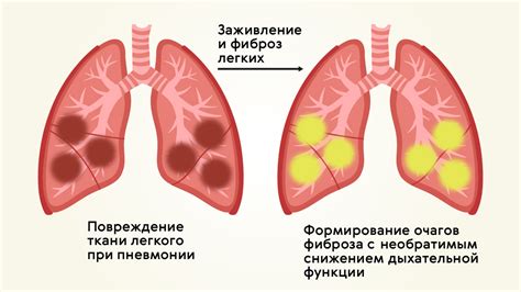 Клинические проявления высокого содержания активного белка при воспалении легких