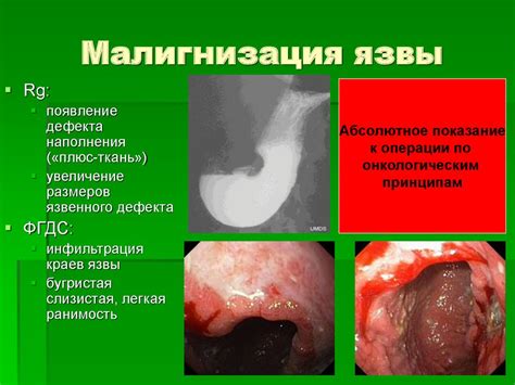 Компликации вируса язвы желудка