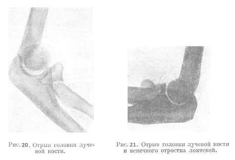 Компьютерная томография – дополнительный метод обнаружения повреждений в области локтевого сустава