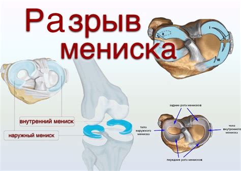 Консервативное лечение повреждения мениска: эффективные методики