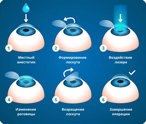 Крио-операция при диссоциации связок глазной оболочки: суть и принцип работы