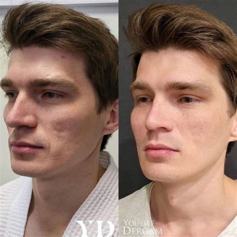 Лечение вирсунгоэктазии