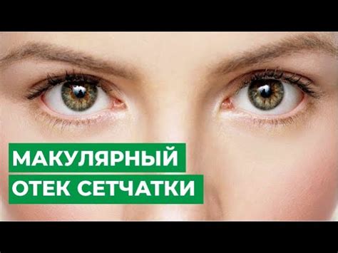 Лечение детей с отслойкой сетчатки: особенности и советы