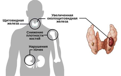 Лечение избыточного выделения гормона при гиперпаратиреозе у женщин