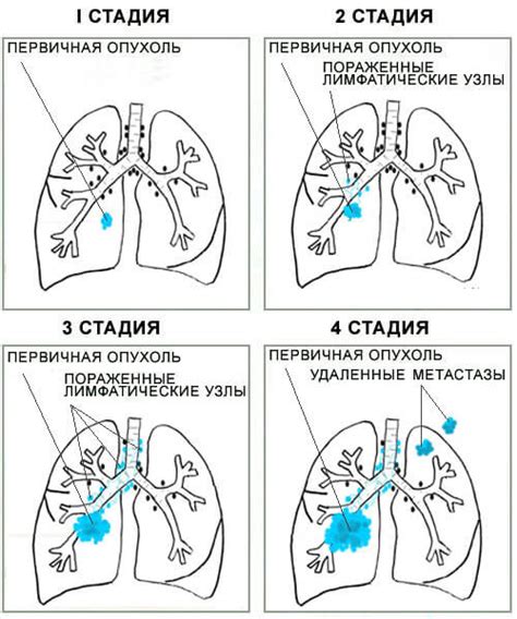 Лечение отечности конечностей у пациентов с диагнозом рак легких: подходы и методы