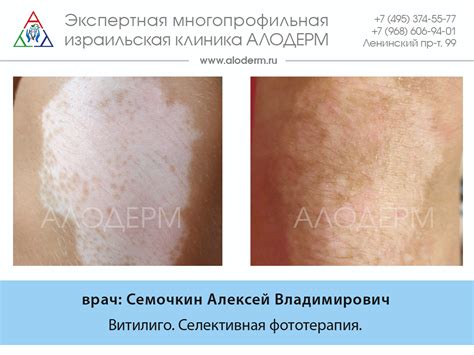 Медикаментозное лечение витилиго