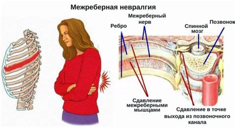 Межреберная невралгия: понятие и взаимосвязь с ощущением ротации