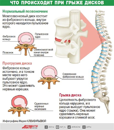 Методы лечения грыж позвоночника: возможности консервативной и хирургической терапии