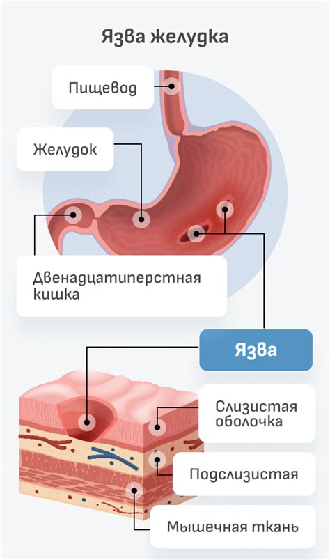 Механизм развития язвы двенадцатиперстной