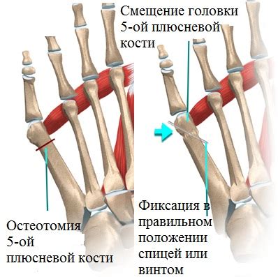 Механизм сгибания пятого пальца