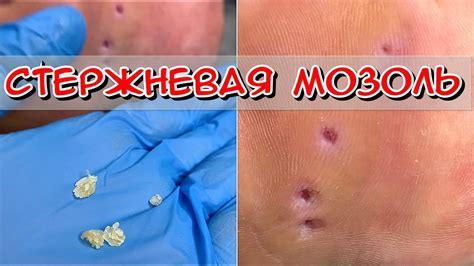 Механическое удаление мозолей: эффективность и безопасность