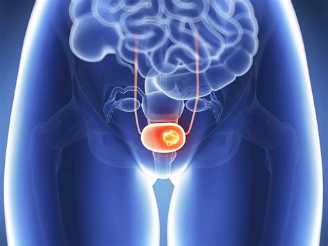 Мочевой пузырь у мужчин: новообразование, симптомы, диагностика и лечение