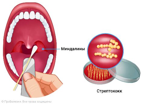 Небезопасность самостоятельного удаления гноя из миндалин