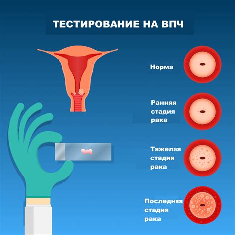 Новообразование шейки матки