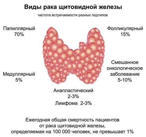 Новообразования щитовидной железы: как их выявить и лечить