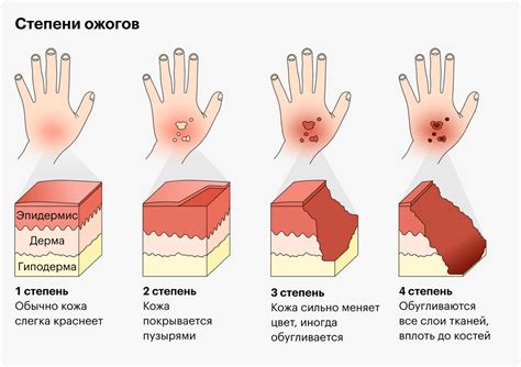 Ожоги: разнообразие видов и степеней тяжести