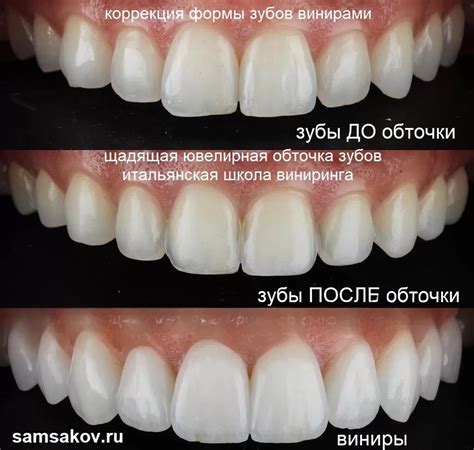 Ознакомьтесь с различными типами виниров и выберите идеальную для вас