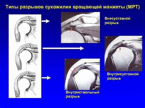 Описание анатомии акромиона по исследованию Биглиани