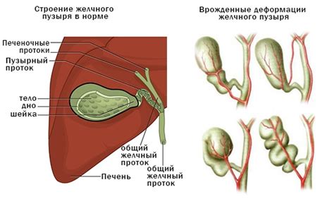 Описание перегиба желчного пузыря