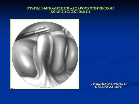 Описание процедуры выполнения проколов при холецистэктомии