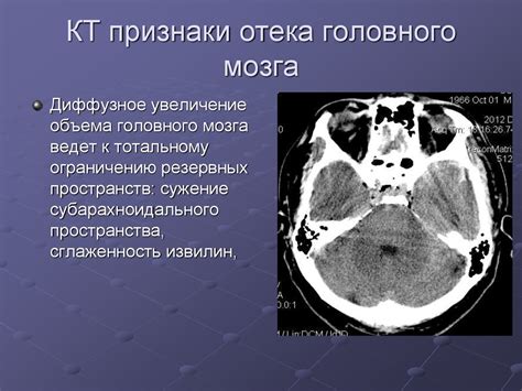 Определение КТ головного мозга и его значение для диагностики