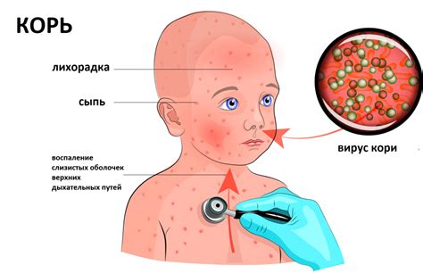 Определение заболевания: как правильно диагностировать корь у взрослых