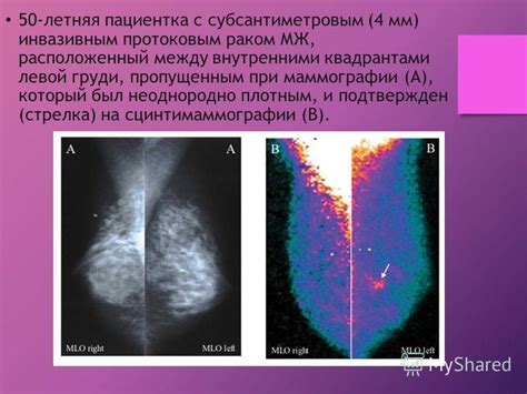 Определение и значимость маммографии в диагностике заболеваний молочной железы