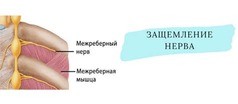 Определение и механизмы возникновения межреберной невралгии