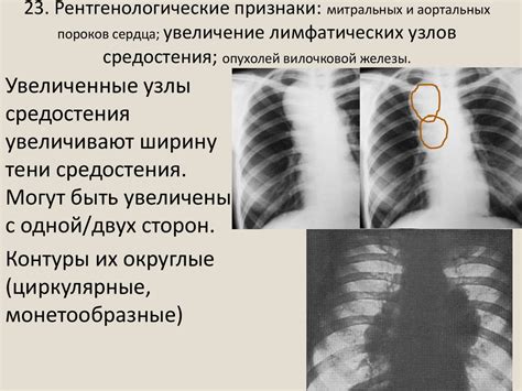 Определение новообразования средостения