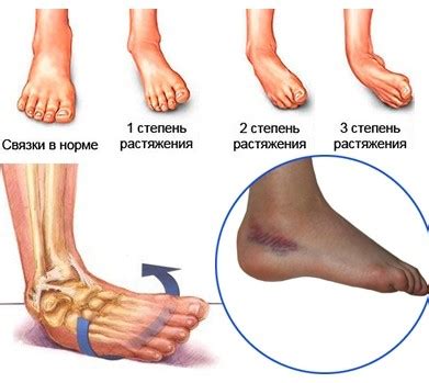 Определение симптомов растяжения и ушиба ноги