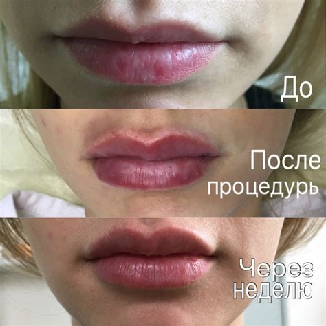 Осложнения после процедуры увеличения объема губ и их эффективное лечение