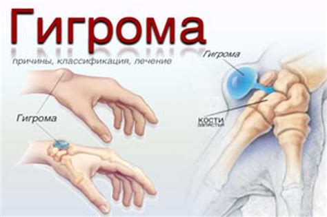 Основная информация о деформации лучезапястного сустава 2 степени