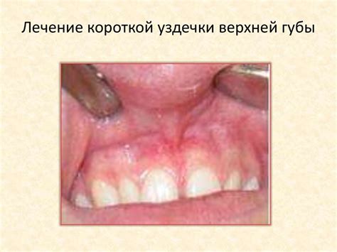 Основные признаки слишком короткой связки верхней губы