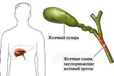 Основные причины изменения структуры желчного органа