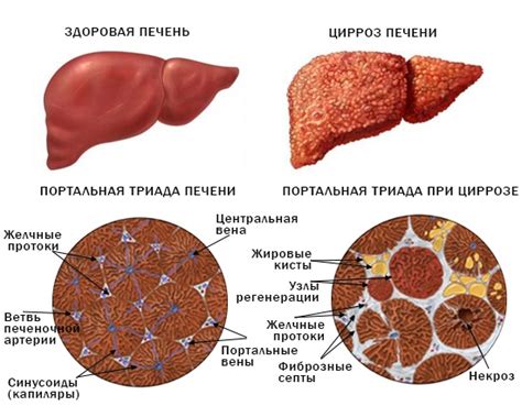 Основные причины и симптомы цирроза печени