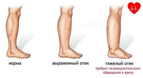 Основные проявления отечности ног и ее негативные последствия