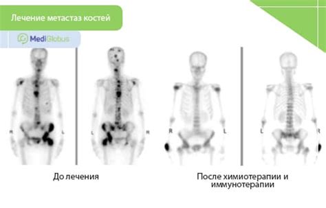 Основные факторы, способствующие развитию метастазов без первичной опухоли