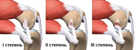 Основы растяжения связок ноги: понятие и принципы