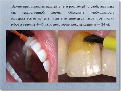 Особенности применения и преимущества ультразвуковой гигиены полости рта