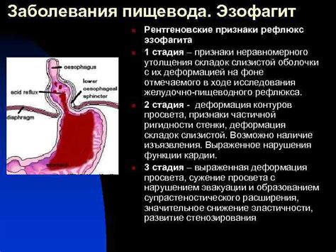 Остальные признаки эзофагита пищевода