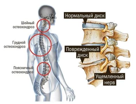 Остеохондроз: причины и симптомы