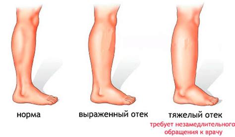 Отеки нижних конечностей: обзор и причины