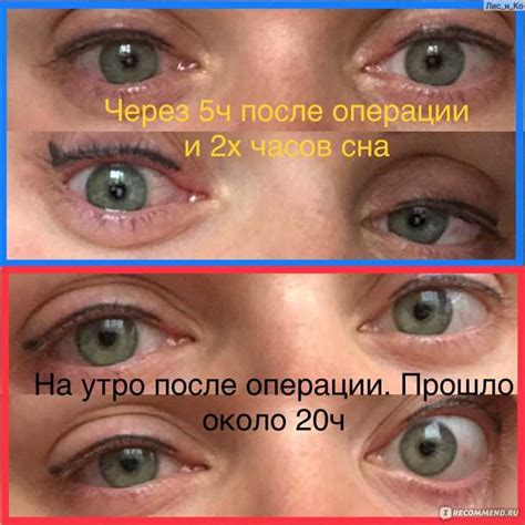 Отзывы пациентов о применении лазерной технологии для коррекции волосяного покрова в области носа